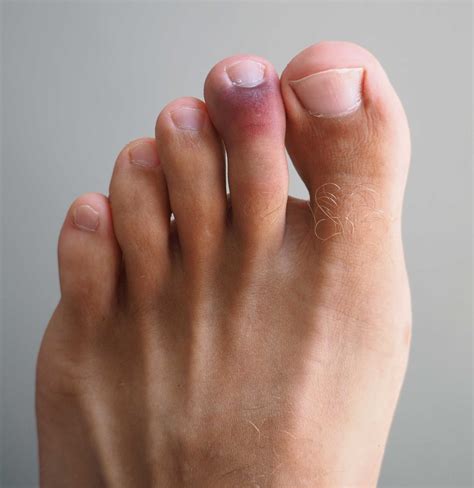 The toe